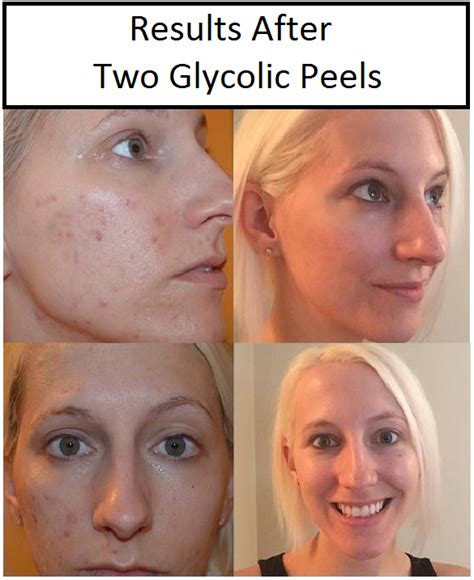 how many glycolic peels to see results|Everything You Need To Know Before Getting a Glycolic Acid Peel.